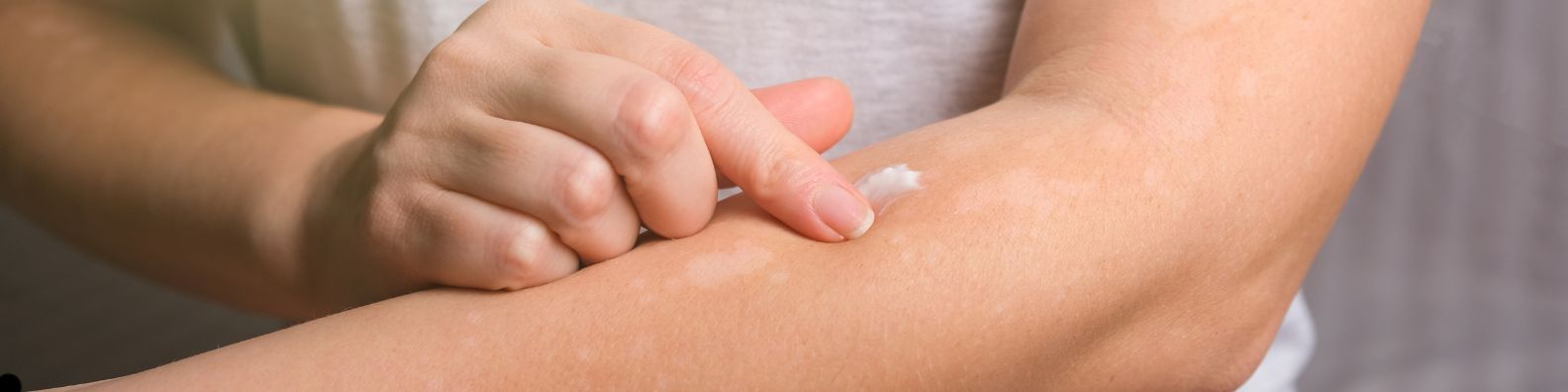 Arm mit Neurodermitis