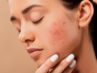 acne-5561750_1920